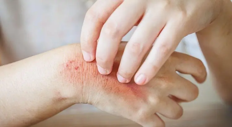 علاج التهابات الجلد